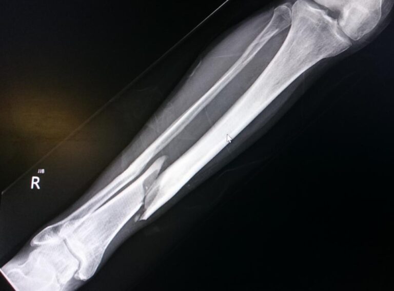 what_to_know_about_a_tibia_fracture